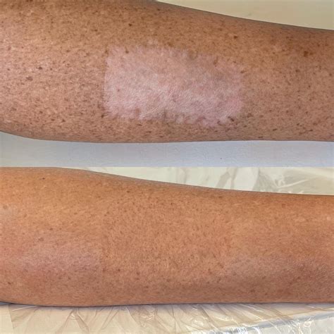 Scar Camouflage Tattoo | Conceal & Transform Your Scars — OC BEAUTY CO ...