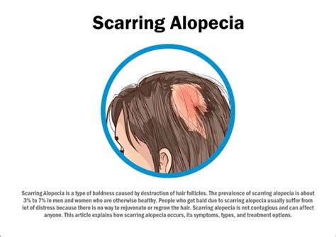 Scarring Alopecia - Symptoms, Causes, Treatment & Prevention | RichFeel