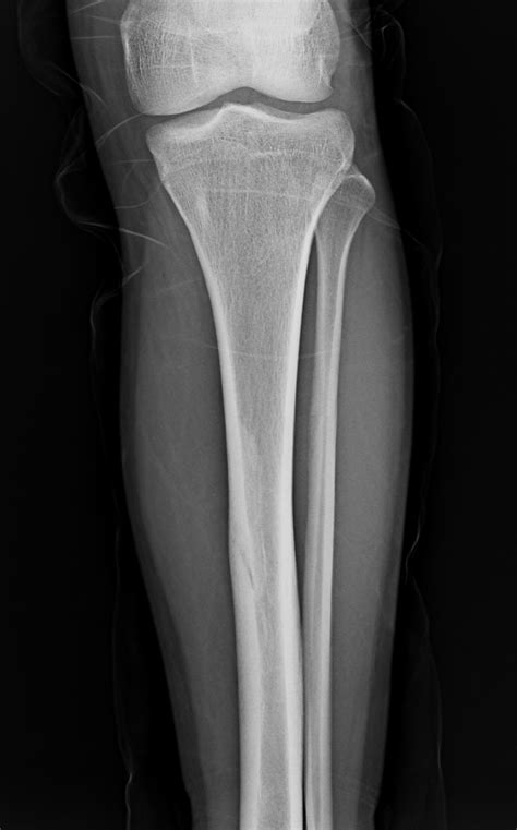 Stress Fracture X Ray Tibia