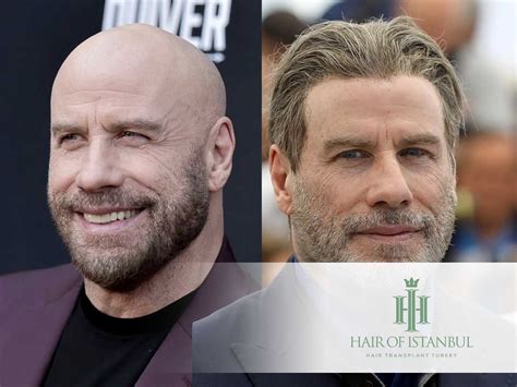 John Travolta Hair Transplant: An In-Depth Investigation!