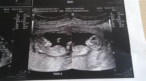 13 Weeks Pregnant Ultrasound Twins