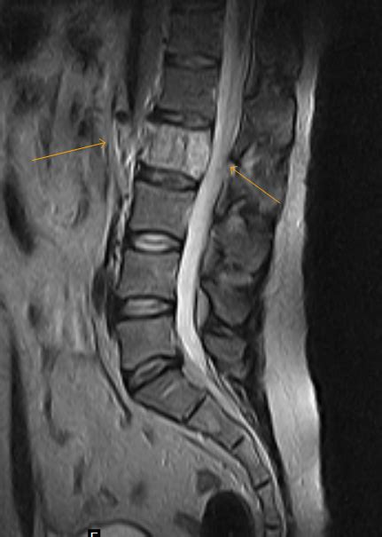 Hemangioma spine - pastorstyle