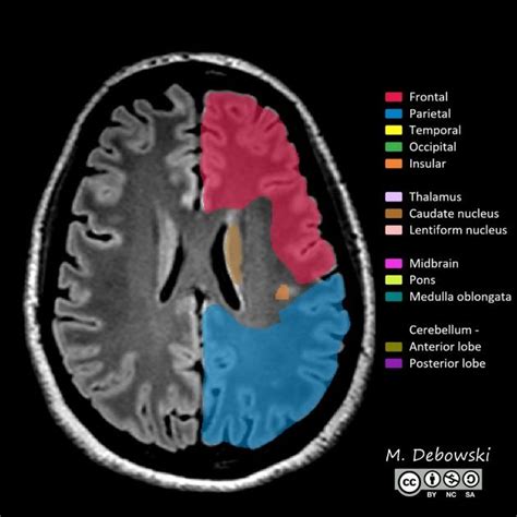 Cerebral hemisphere | Radiology Reference Article | Radiopaedia.org ...