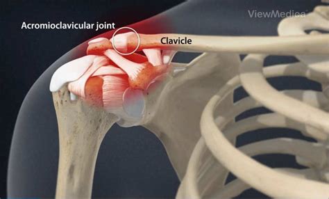 Acromioclavicular AC Joint