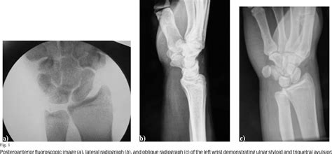 Dislocated wrist | Semantic Scholar