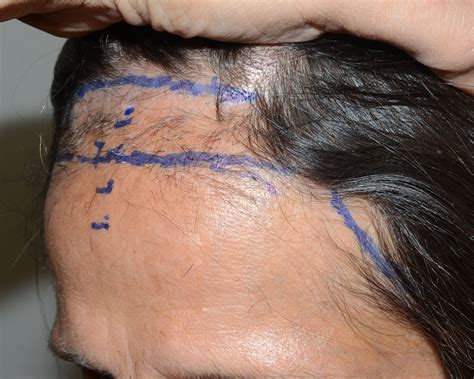 Frontal Fibrosing Alopecia - Dr Epstein