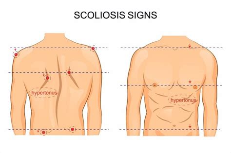 What are the symptoms, risk factors and complications of scoliosis?