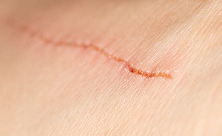 The Wound Healing Process | WoundSource