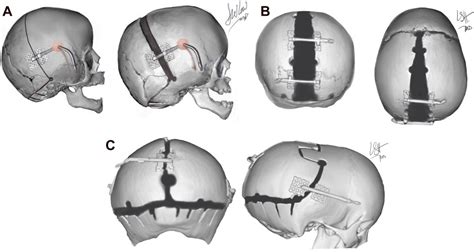 Craniosynostosis | Plastic Surgery Key