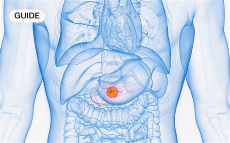 Pancreatic cancer: Symptoms, causes and treatment