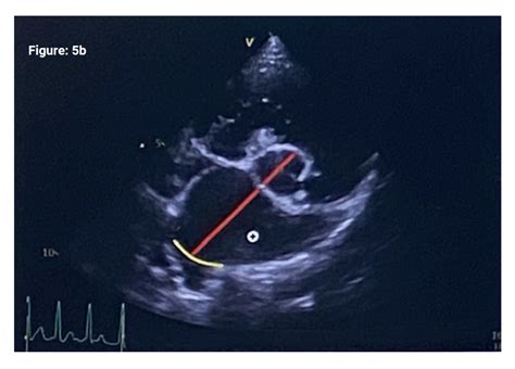 Staging of Preclinical Myxomatous Mitral Valve Disease in Primary ...