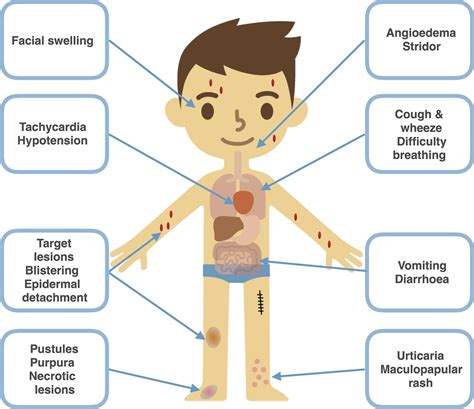 Anaphylaxis Rash / Anaphylaxis, An Overview - Health And Medical ...