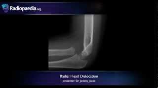 Radial head dislocation - radiology video tutorial (x-ray) | Doovi