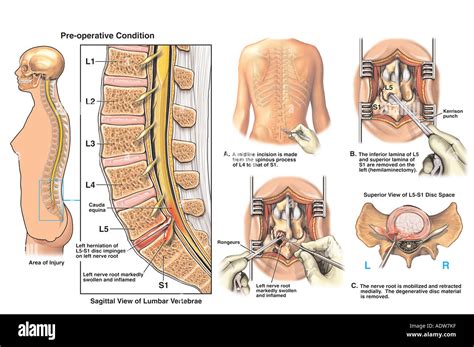 L5-S1 Disc Herniation with Hemilaminectomy and Discectomy Procedure ...