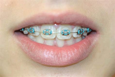 Braces: Metal Braces With Light Blue Bands