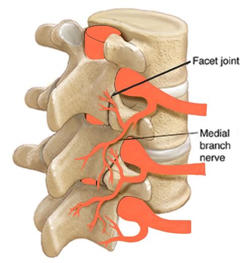 Facet Joint Denervation - Spines Dorset