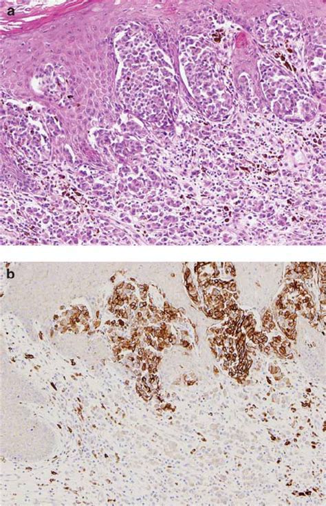 A case of acral-lentiginous melanoma showing strong and diffuse ...