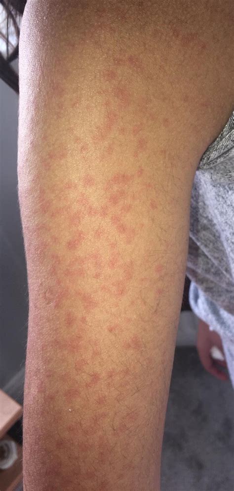 Viral Rash On Arms