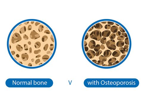 DXA Scan - Irish Osteoporosis Society