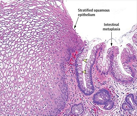 Barretts Esophagus Histology