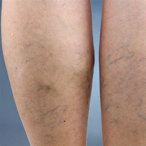 Varicose Veins Treatment in El Paso & Las Cruces