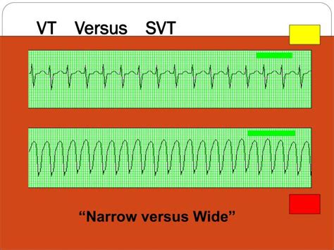 Ppt Cardiovascular Ekgs Cardiac Monitoring Powerpoint