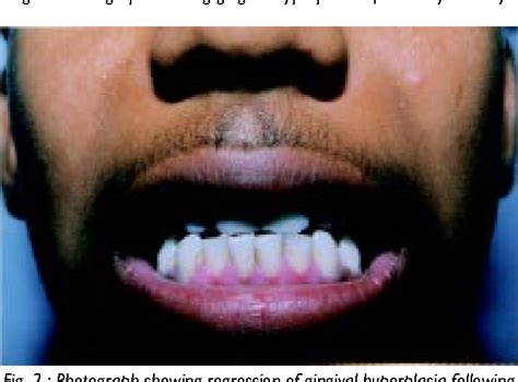 Figure 2 from Amlodipine-induced gingival hyperplasia. | Semantic Scholar