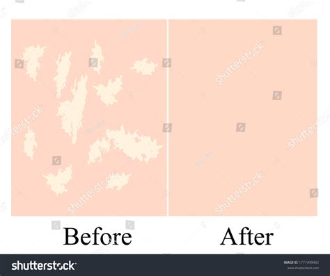 Vitiligo White Spots On Skin Infographics Stock Illustration 1777499942 ...