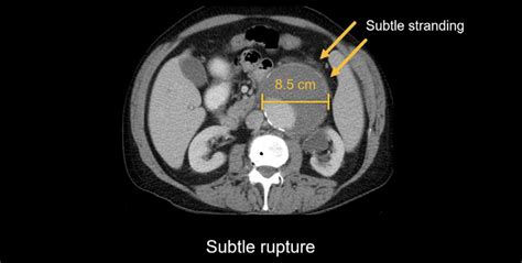 Abdominal CT: aortic aneurysm • LITFL • Radiology Library