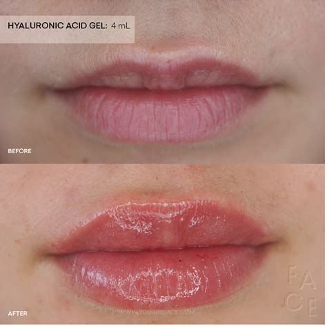 Needleless Lip Filler: What It Is & How It Compares to Injectables — FACE