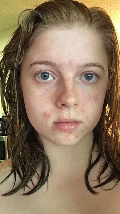 [Acne] Ive been suffering from acne mostly on the lower part of my face ...