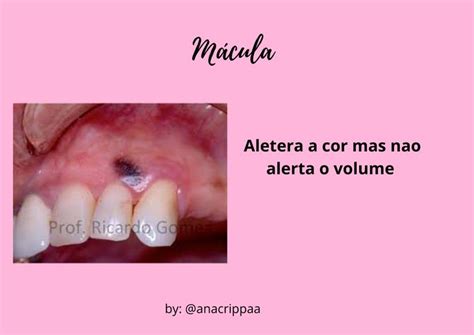 macula | Bucal, Odontología, Patologia