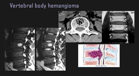 Vertebral Hemangioma