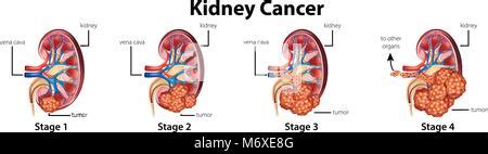 Diagram showing different stages of kidney cancer Stock Vector Image ...