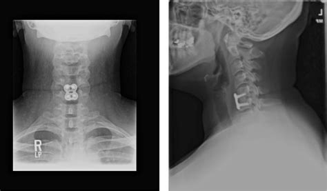 Cervical Herniated Disc | OrthoManhattan