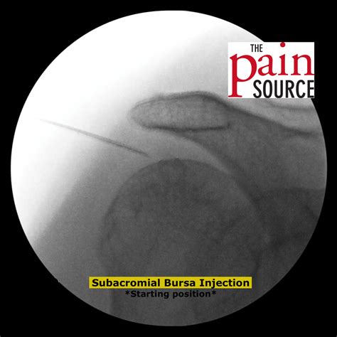 Subacromial Bursa Injection – Technique and Tips - The Pain Source ...