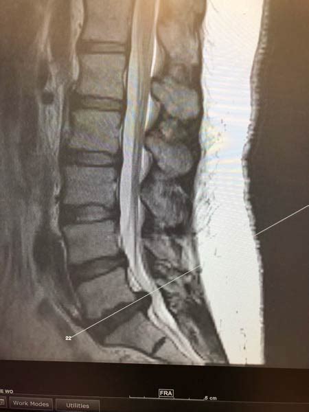 Lumbar Disc Herniation - Stechison Neurosurgery Atlanta, LLC