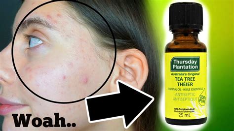 Tea Tree Oil Acne Before And After