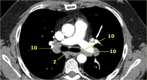 The Radiology Assistant : Mediastinum - Lymph Node Map