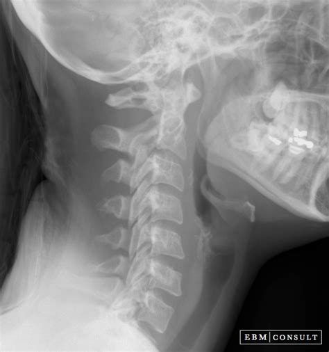 Cervical spine x ray - hetyintra