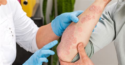 7 Symptoms of Psoriasis and Eczema to Look Out For - DESSNA