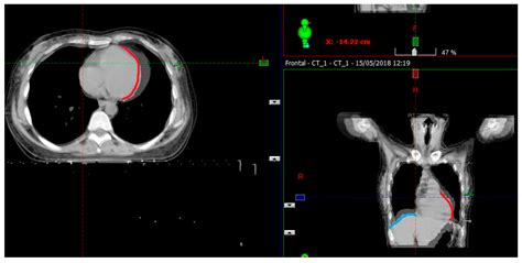 Chest X Ray Emphysema Findings