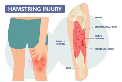 Hamstring Strain Management in Singapore - Straits Podiatry