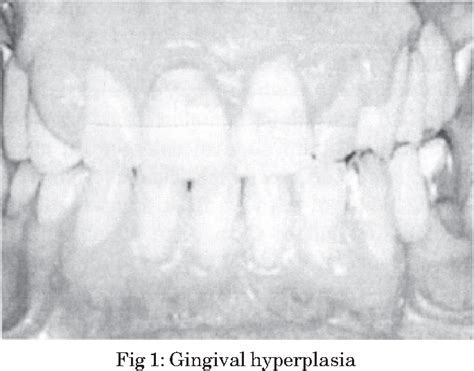 Figure 1 from AMLODIPINE INDUCED GINGIVAL HYPERPLASIA | Semantic Scholar