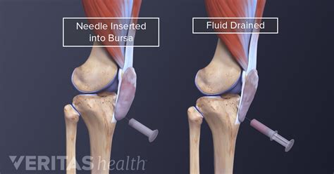 Knee Bursas Bursitis Knee Bursitis Prepatellar Bursitis Images