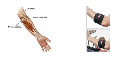 Lateral Epicondylitis: Treatment Options For An Aggravating, 47% OFF