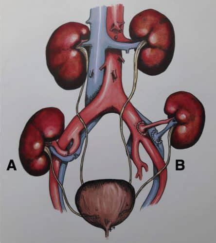 Renal Transplantation - TeachMeSurgery