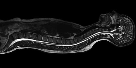 MRI Scan – Importance, Procedure & Cost in India