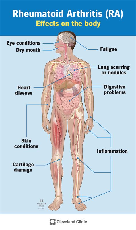 Understanding Arthritis: Causes, Symptoms, And Treatment - Ask The ...