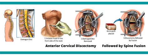 Anterior Cervical Discectomy and Fusion ( ACDF ) Surgery in Mumbai | Dr ...